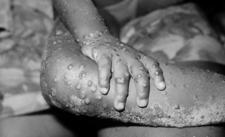  Maymun Çiçek Virüsü (Monkeypox) Nedir? Yeni Bir Pandemi Kapıda mı?