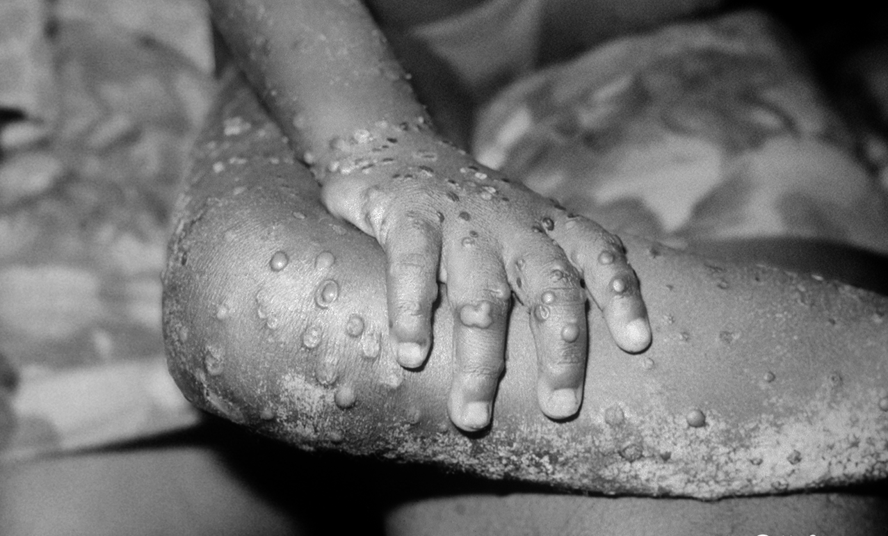 Maymun Çiçek Virüsü (Monkeypox) Nedir? Yeni Bir Pandemi Kapıda mı?